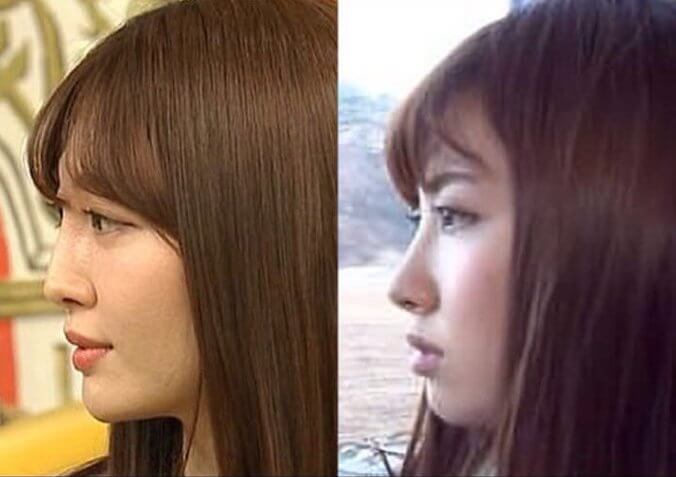 小嶋陽菜の整形前と後のビフォーアフター